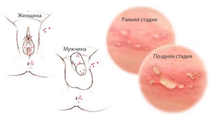 gerpes-v-intimnoj-zone