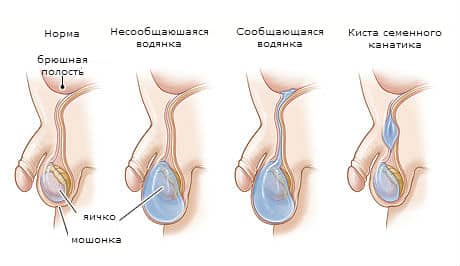 Киста семенного канатика у мальчиков