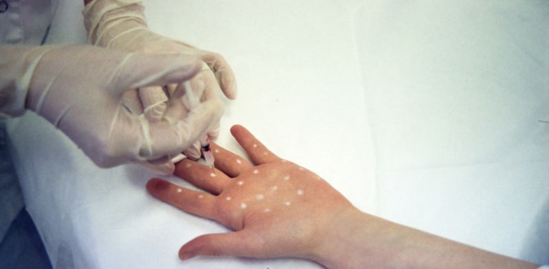 Что такое гипергидроз и как его лечить