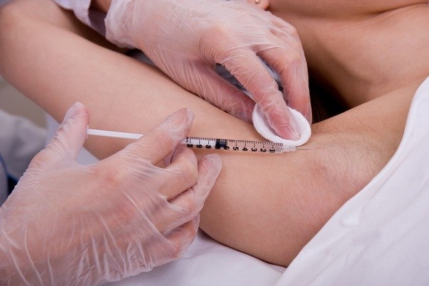 лечение гипергидроза