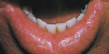 гландулярный хейлит фото