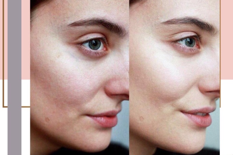 Фото до и после процедуры BB glow