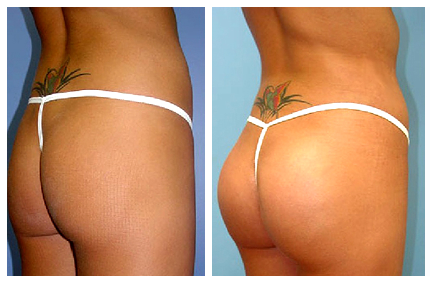 фото до и после глютеопластики