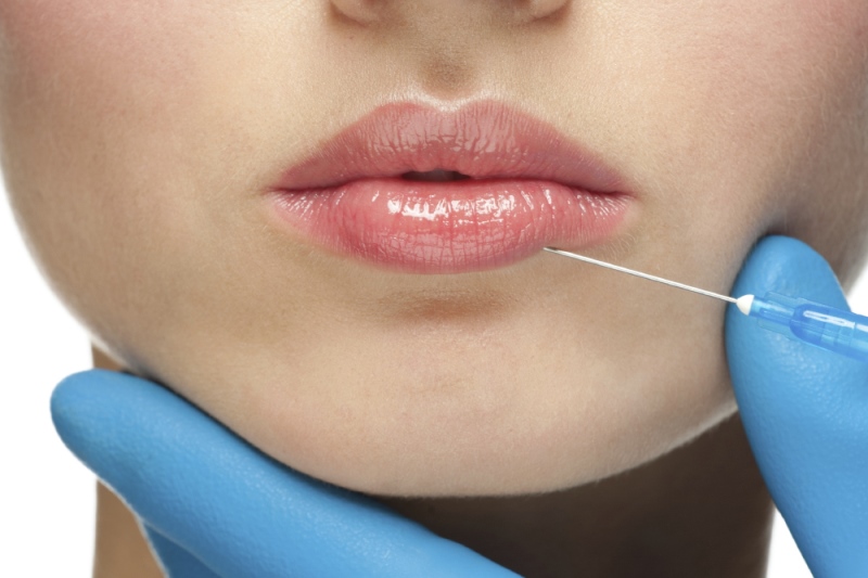 Увеличение губ гиалуроновой кислотой