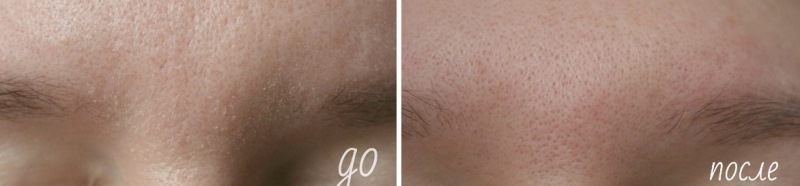 Пилинг скатка Пропеллер до и после