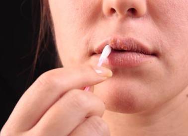 герпес при беременности лечение