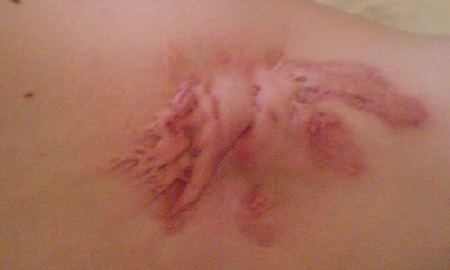 Какое средство от рубцов от прыщей самое эффективное