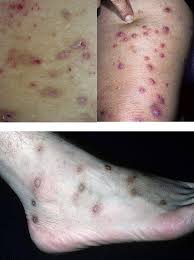 Почесуха - все про болезнь