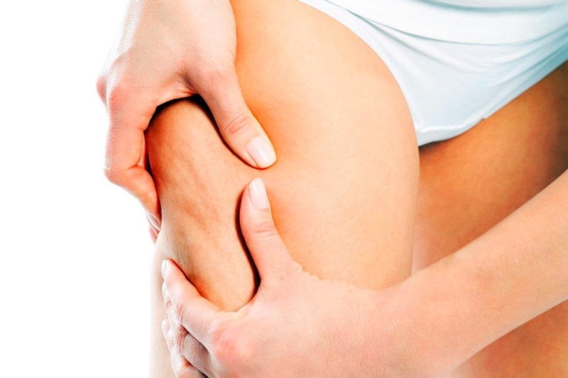 Целлюлит на ногах