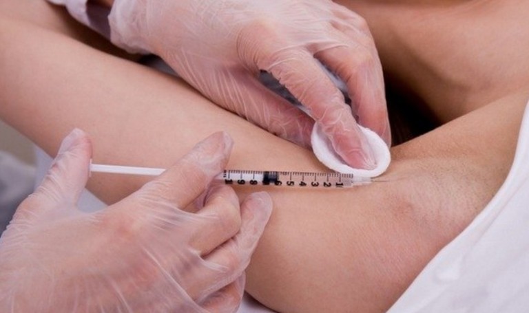 Ботокс в подмышки