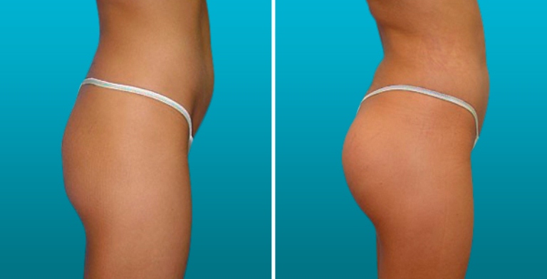 Липофилинг ягодиц до и после