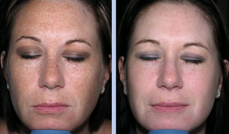 До и после пилинга Джесснера