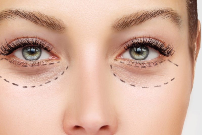 Блефаропластика век