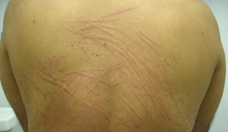 kak-lechit-krapivnicu-u-vzroslogo