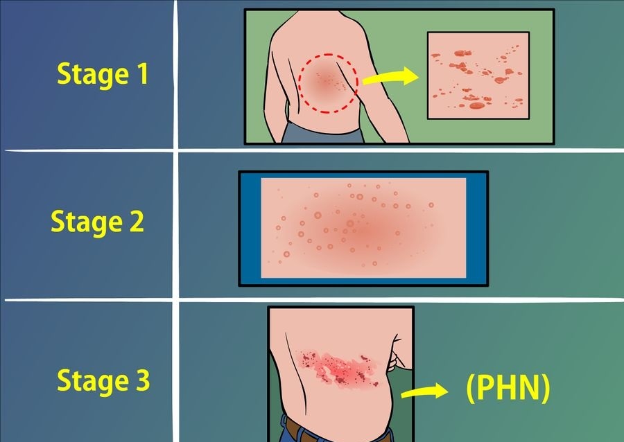 kak-peredaetsya-lishaj