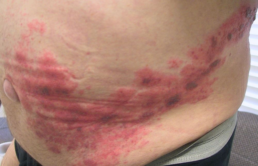 kak-peredaetsya-opoyasyvayushhij-lishaj-foto