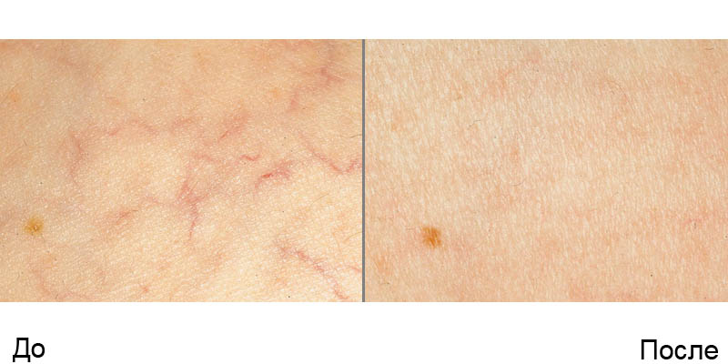 kak-ubrat-sosudy-na-lice-foto