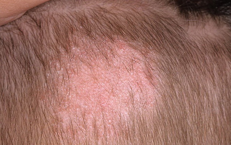 Лишай стригущий у человека