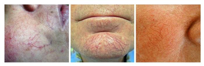 kak-vyglyadit-kuperoz-na-lice-foto