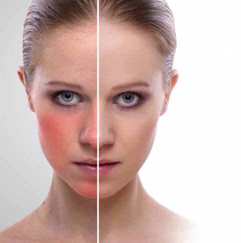 kak-vyglyadit-kuperoz-na-lice