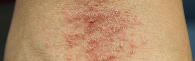 Кожный дерматит и все про него