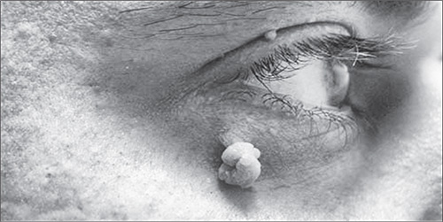 kak-vyglyadit-papilloma-foto