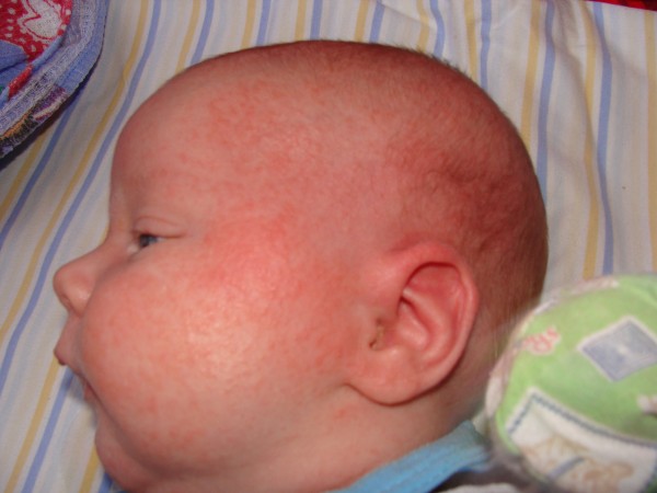 kak-vyglyadit-potnichka-u-grudnichkov-na-golove-foto