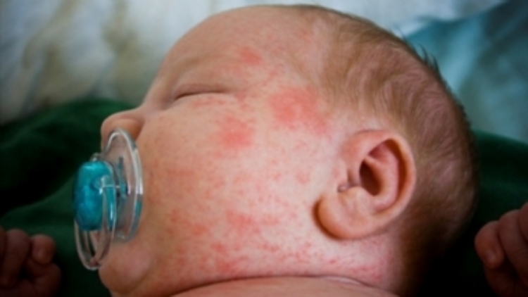 kak-vyglyadit-potnichka-u-grudnichkov-na-lice-foto