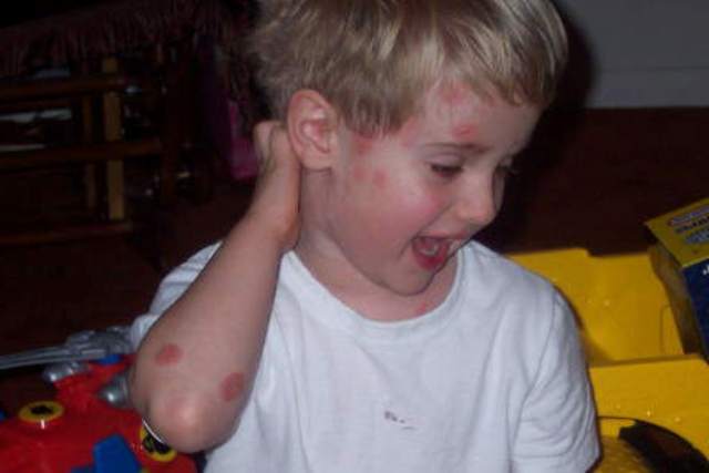 kak vyglyadit psoriaz foto 1