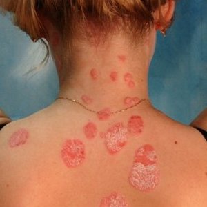 kak vyglyadit psoriaz foto