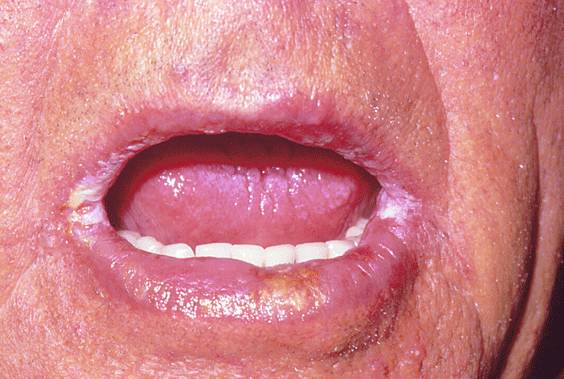 Кандидозный хейлит фото