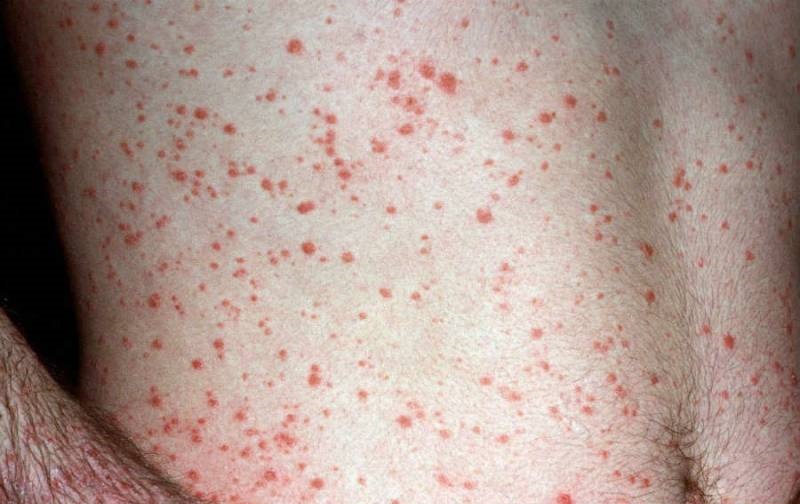 kaplevidnyj psoriaz foto 1