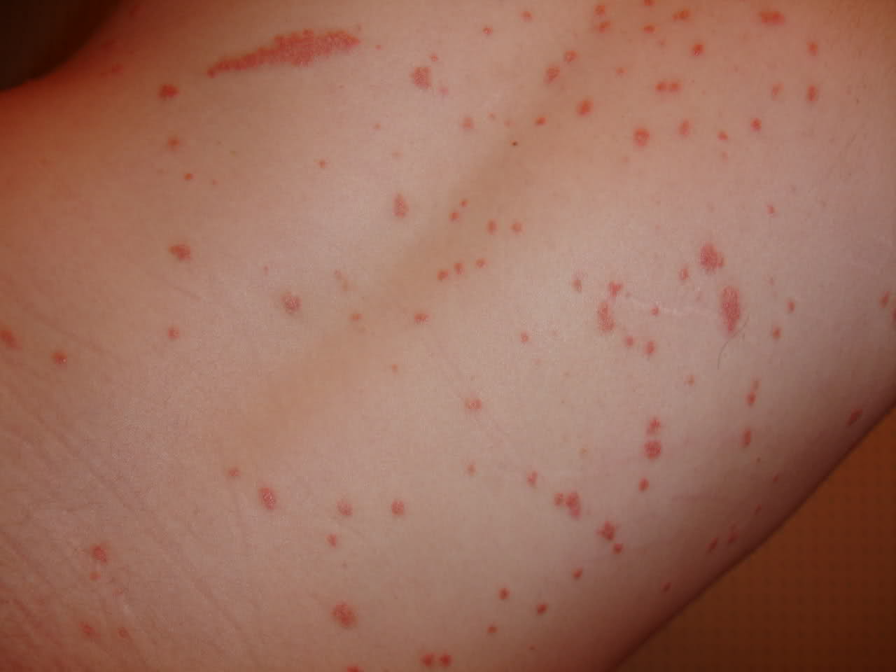 kaplevidnyj psoriaz foto