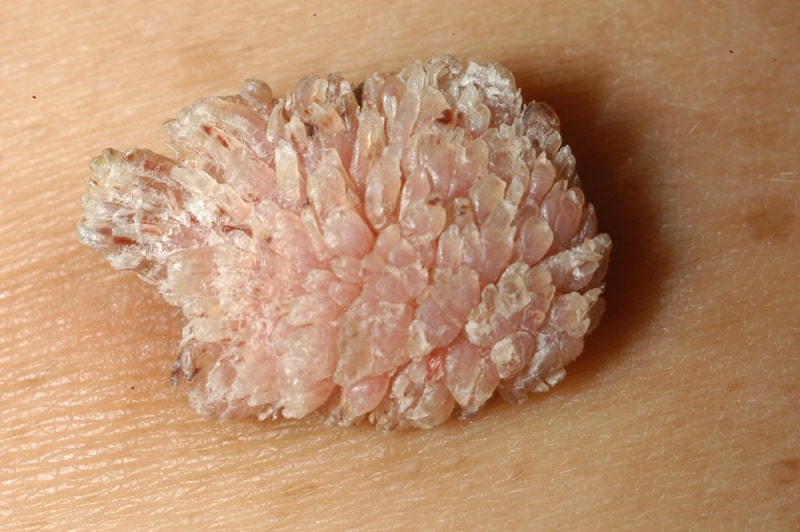 Фото кондиломы во влагалище