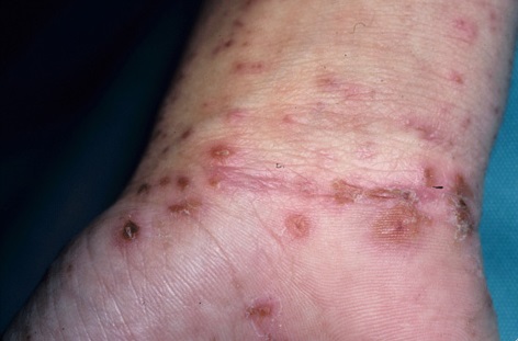 Прыщ на ладони: причины возникновения и методы устранение