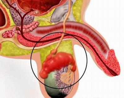 Киста семенного канатика у мальчиков