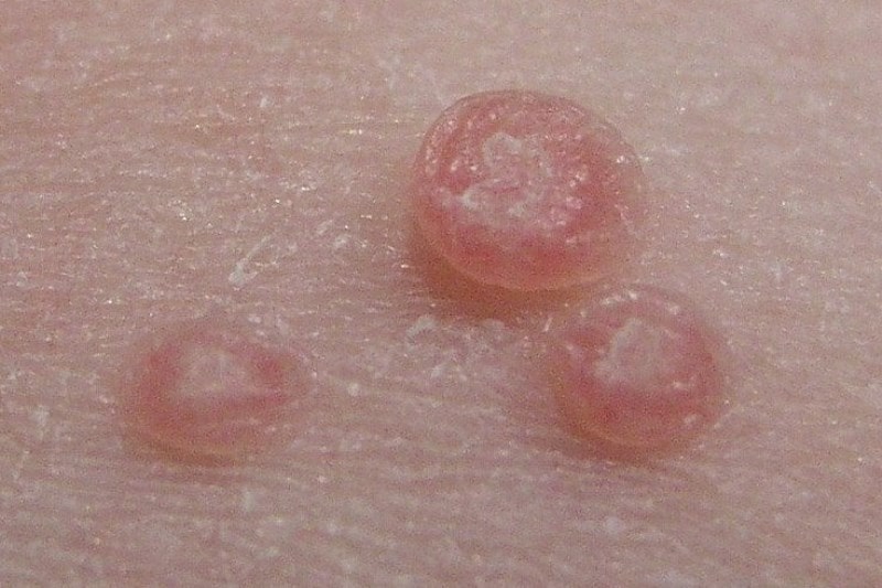 Фото кондилом возле влагалище