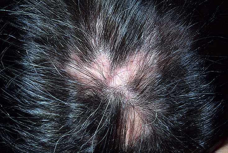 красная волчанка фото