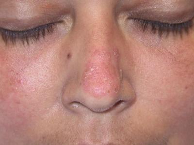 красная волчанка на носуфото