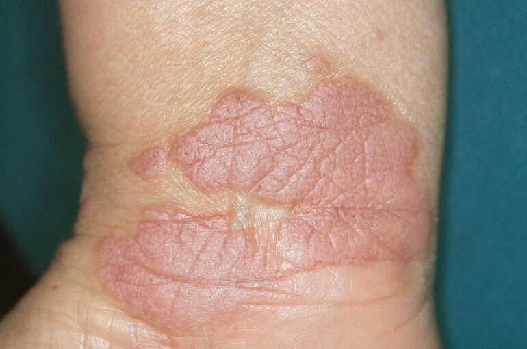 красный лишай у человека симптомы лечение фото