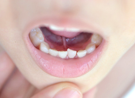 krasnyj-ploskij-lishaj-v-polosti-rta