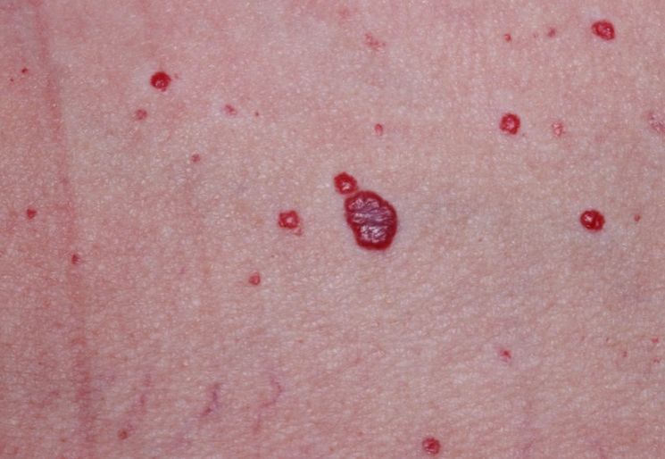 Много гемангиом на лице