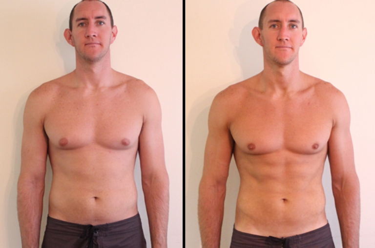 Криолиполиз фото до и после