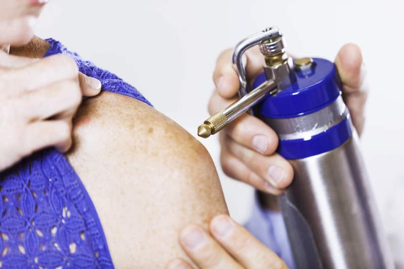 Лечение кератоза криодеструкцией