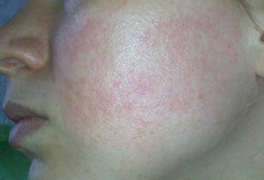 купероз на лице фото