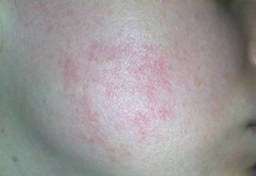 купероз на щеке фото