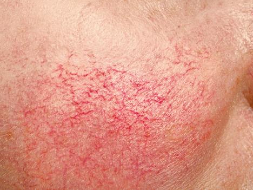 фото сосудистой сеточки