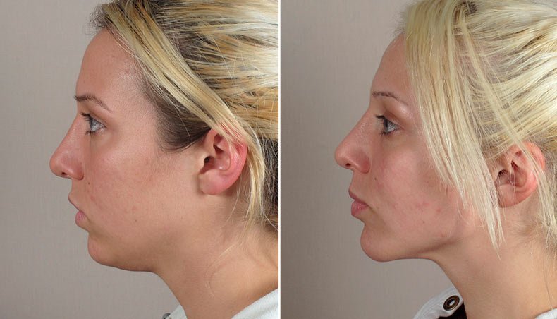 Фото до и после липосакции подбородка