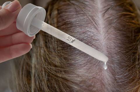 как лечить алопецию медикаментозным способом