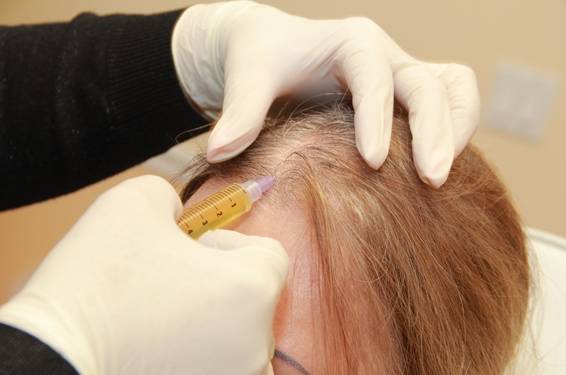 лечение алопеции уколами